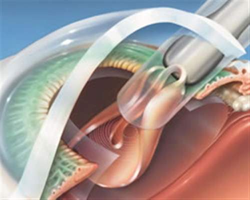  بیماری کاتاراکت یا آب مروارید